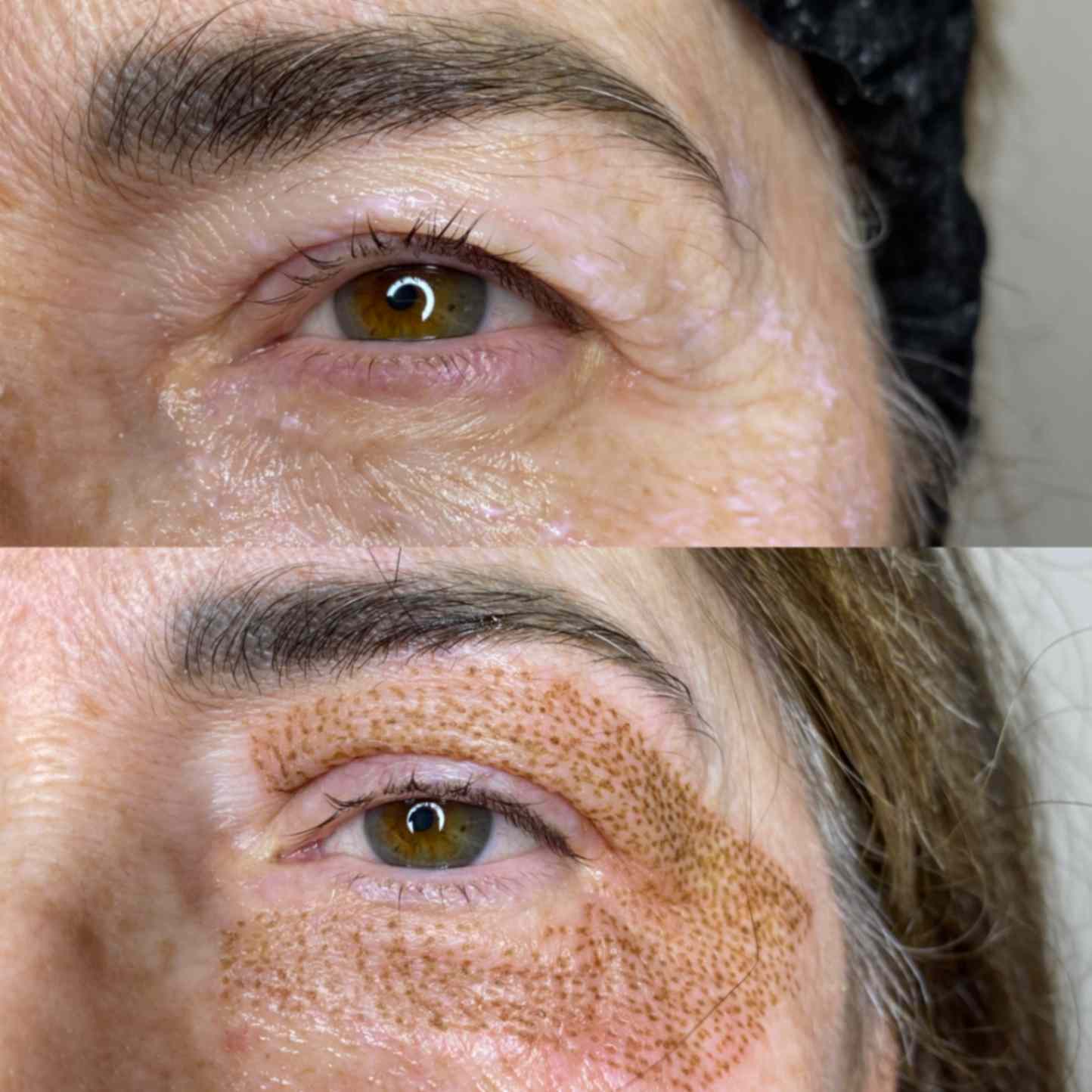 Blefaroplastia sin cirugía