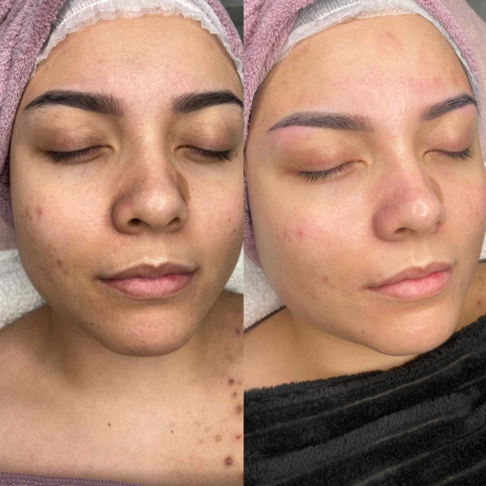 Limpieza facial profunda ante y despues.peg