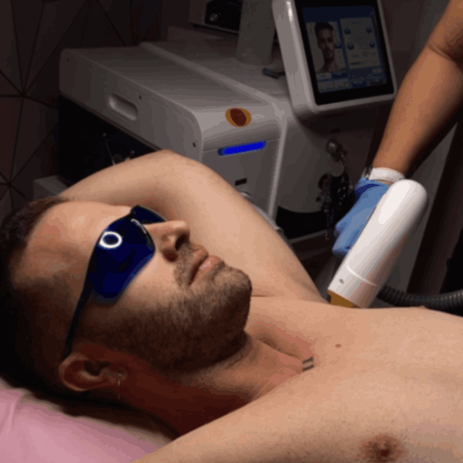 depilación laser