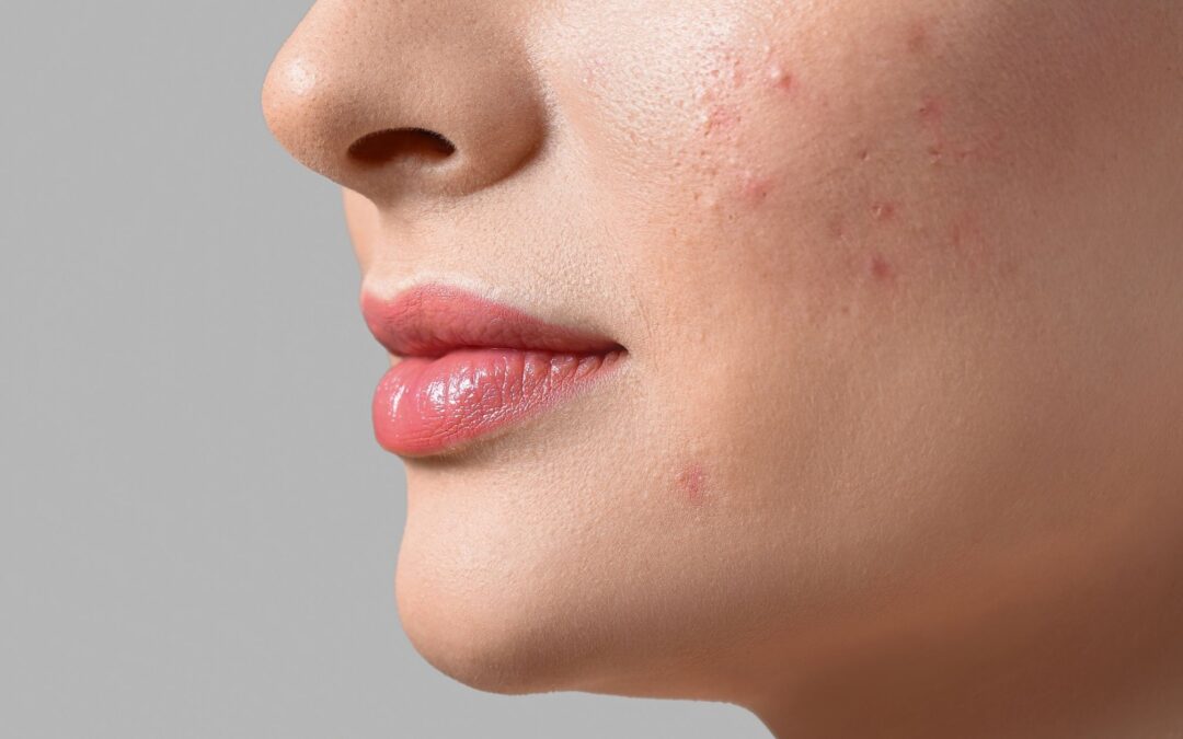 Cómo disimular marcas de acné con maquillaje